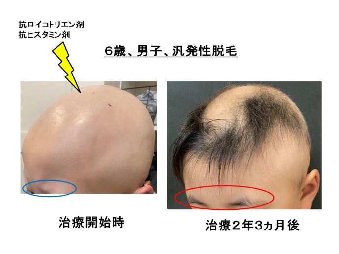 円形脱毛症　病院
